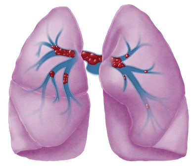 Pulmonary embolism diagnosis and respiratory care by Dr. Daksh Sharma