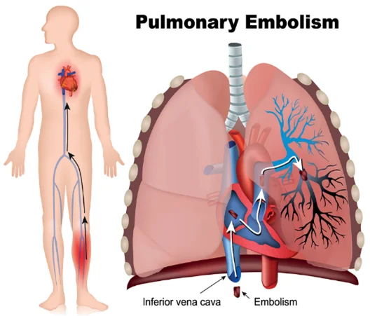 Pulmonary embolism lung condition treatment by Dr. Daksh Sharma