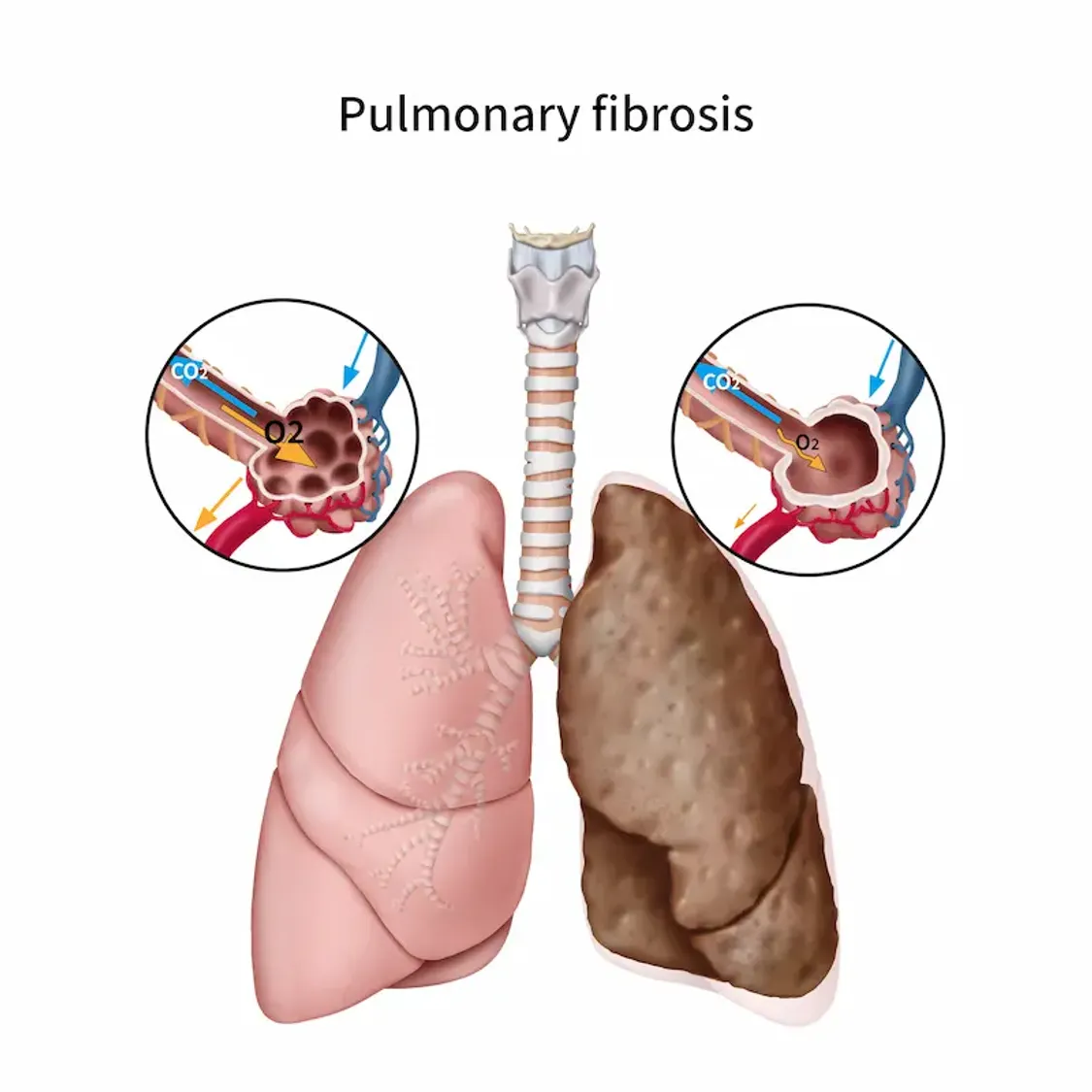 Pulmonary embolism diagnosis and treatment by Dr. Daksh Sharma in Bhopal