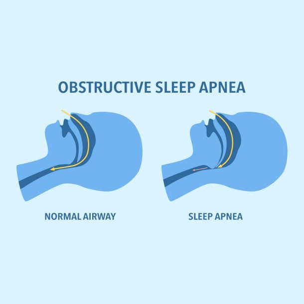 Obstructive sleep apnea diagnosis by Dr. Daksh Sharma in Bhopal
