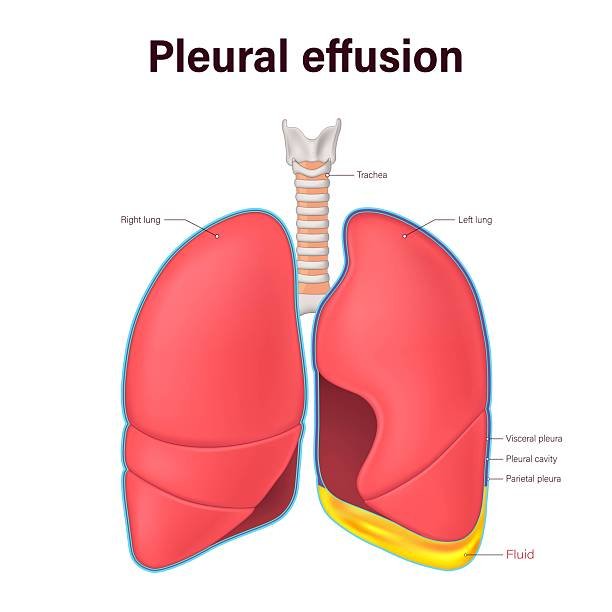 Pleural effusion showing fluid buildup around the lungs, treated by Dr. Daksh Sharma in Bhopal