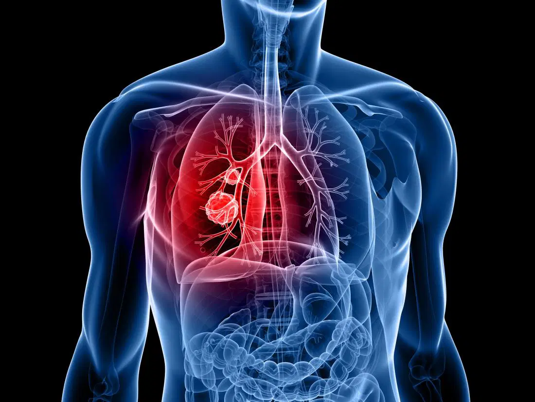 Lung cancer specialist Dr. Daksh Sharma in Bhopal