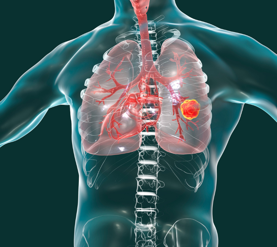 Lung cancer treatment by Dr. Daksh Sharma in Bhopal