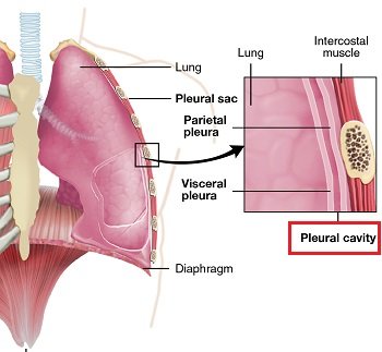 Pyothorax causing infected fluid around the lungs, treated by Dr. Daksh Sharma in Bhopal