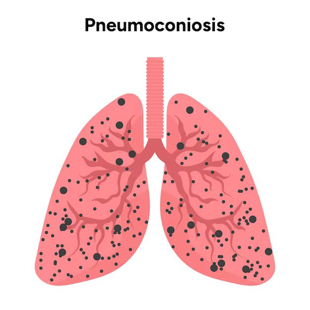 Pneumoconiosis lung disease and respiratory condition treatment in Bhopal by Dr.Daksh Sharma