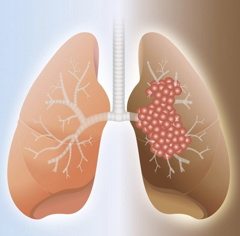 Pulmonary fibrosis treatment by Dr. Daksh Sharma in Bhopal