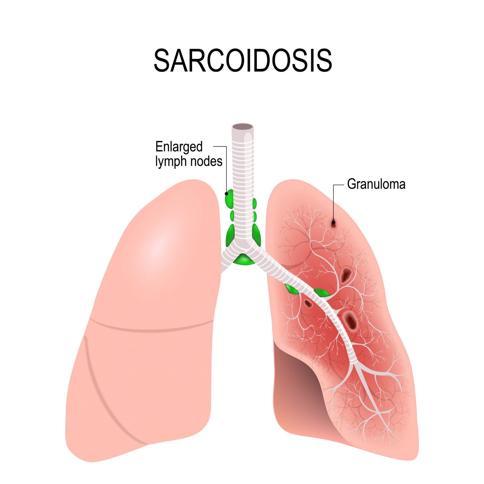 Sarcoidosis treatment by Dr. Daksh Sharma in Bhopal