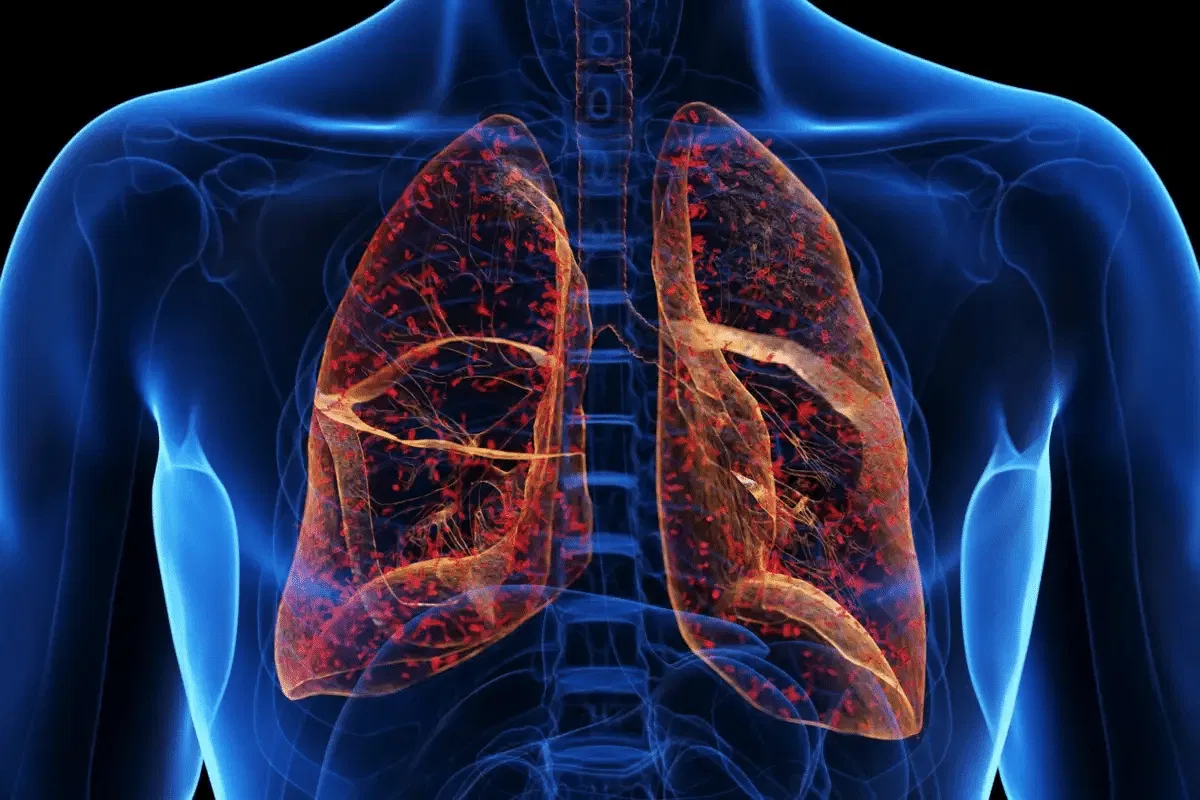 Pneumonia diagnosis and treatment by Dr. Daksh Sharma in Bhopal